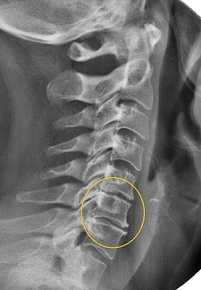 Narrowing of the intervertebral space in x-ray