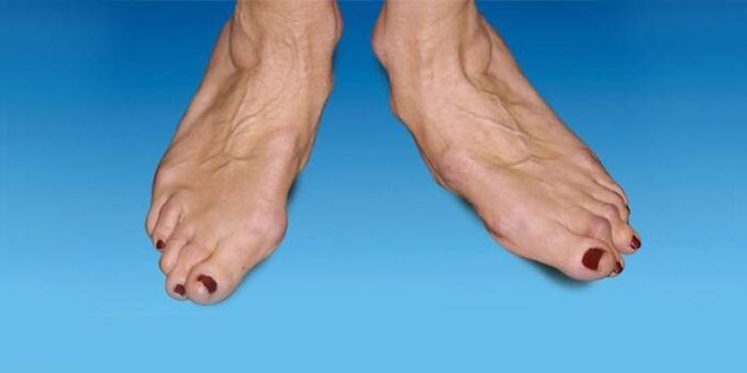 deformity of the foot with osteoarthritis in the ankle