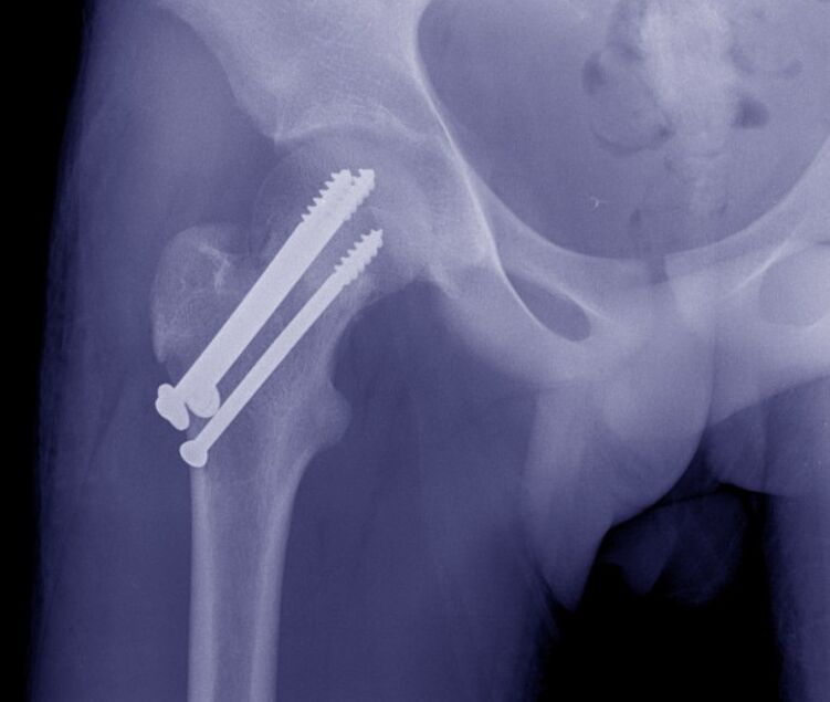 X-ray of the hip joint, fracture osteosynthesis with internal fixation devices