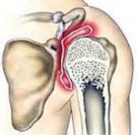 osteoarthritis of the shoulders