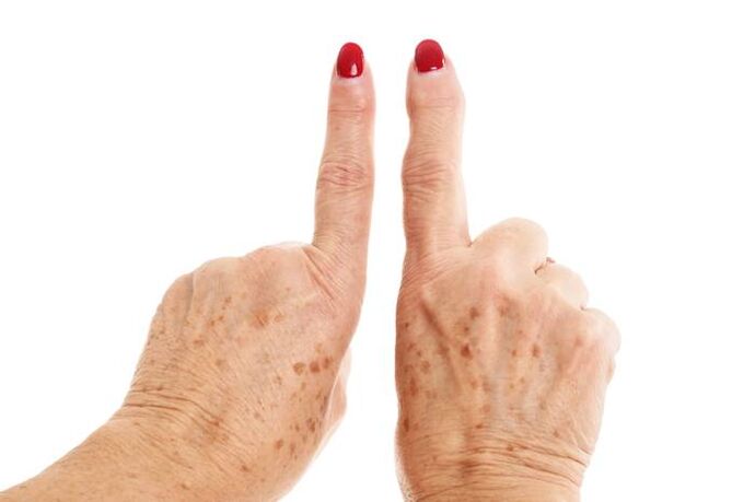 osteoarthritis deformity of the fingers