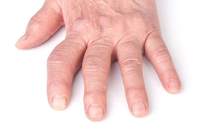 osteoarthritis deformity of the hands