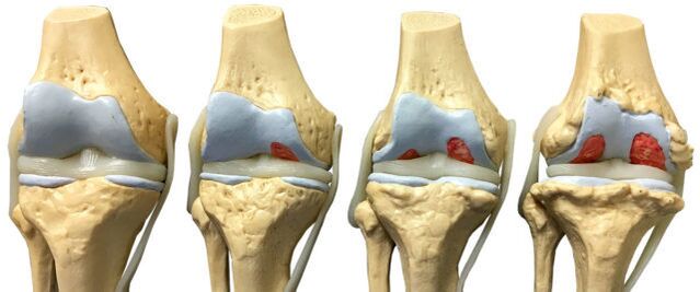 joint damage at different stages of development of ankle osteoarthritis