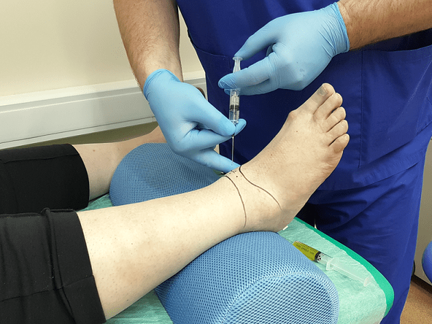 puncture for ankle osteoarthritis