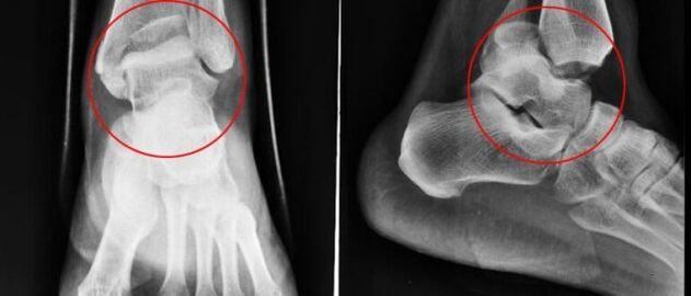 radiograph for ankle osteoarthritis