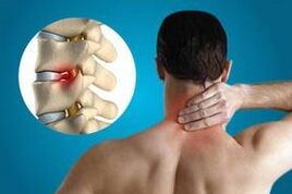 Pinching of vertebrae