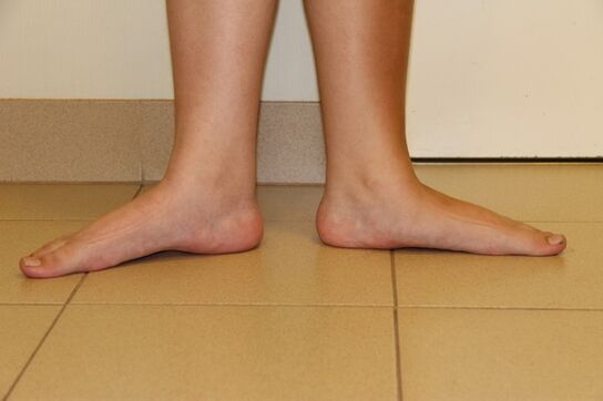 Sometimes the cause of neck arthrosis is flat feet