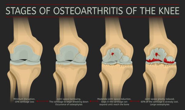 the development of joint arthrosis