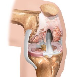 Cartilage coating